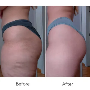 2-Month Body Power Treatment